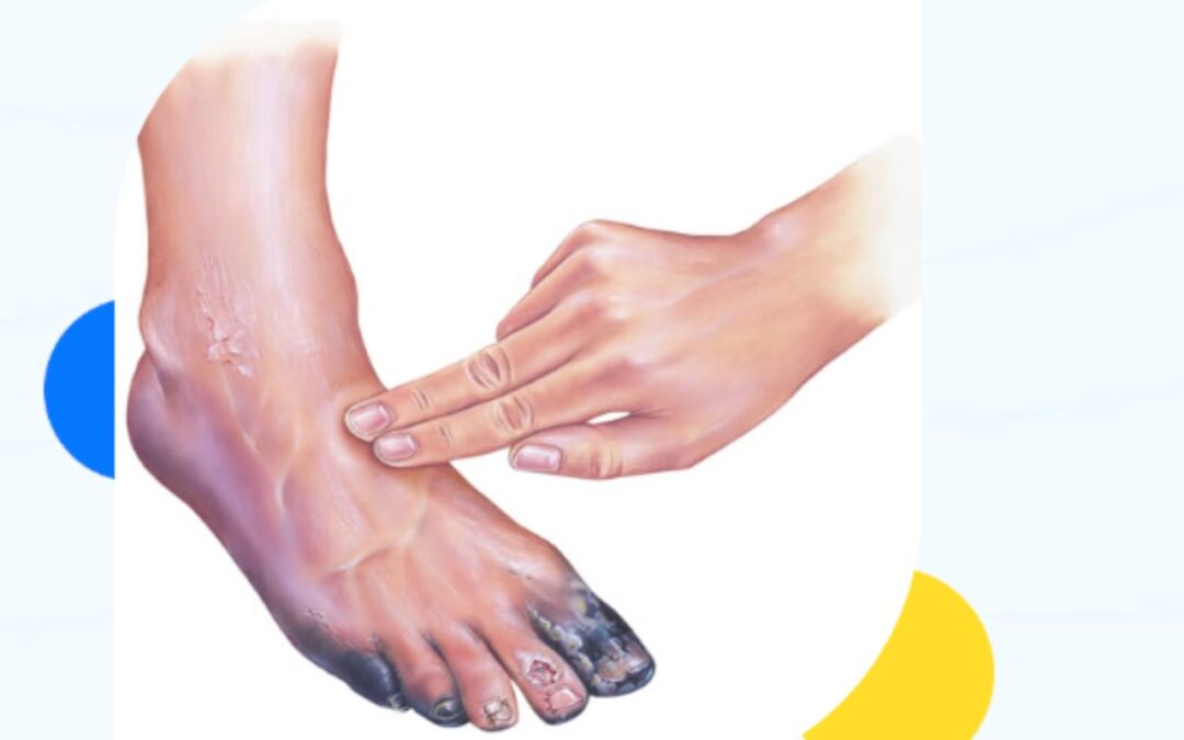 Early Stage Diabetic Foot Ulcer